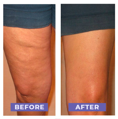 Carebudd™ Anti-Cellulite Suction Cup draft