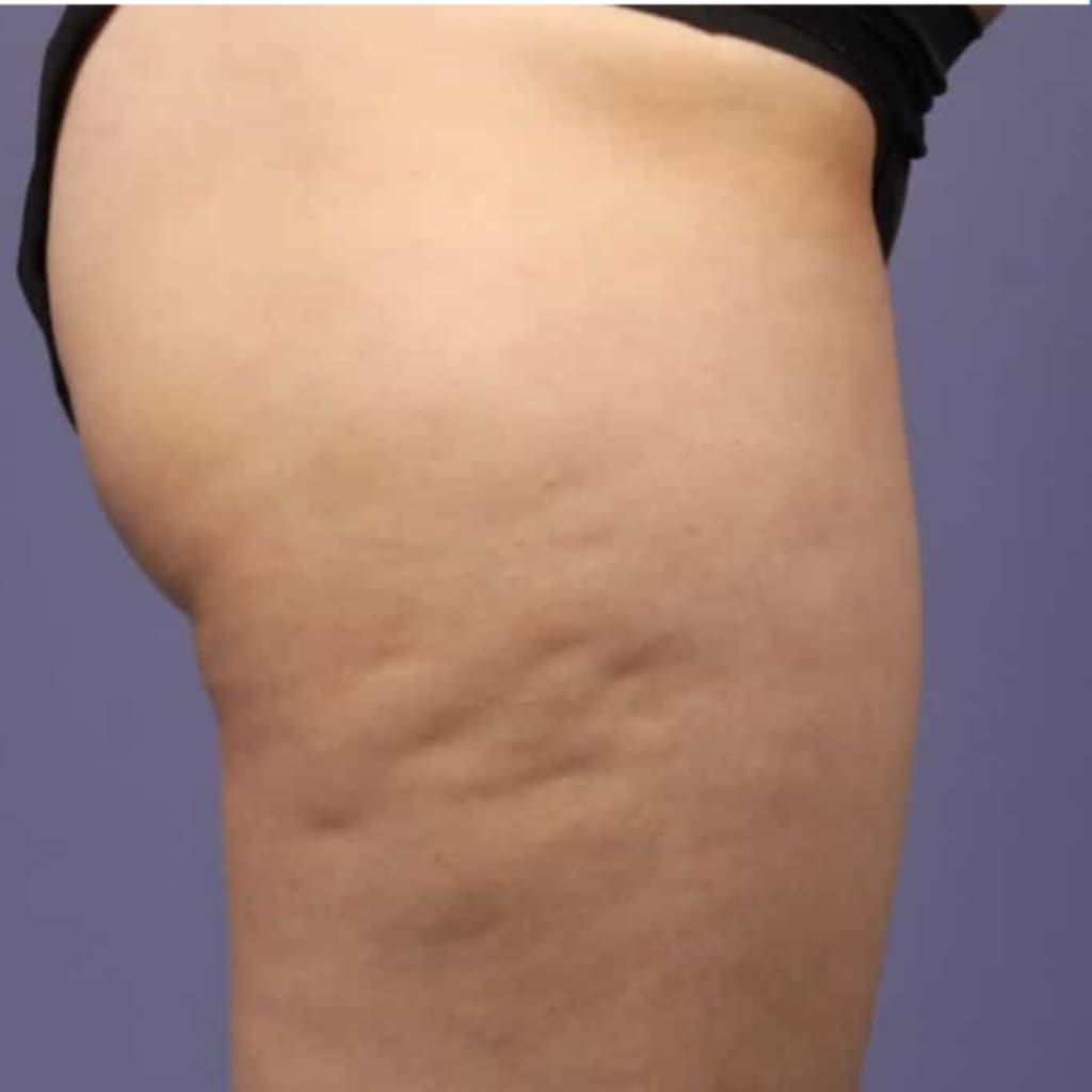 Carebudd™ Anti-Cellulite Suction Cup draft