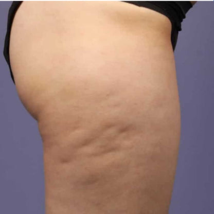 Carebudd™ Anti-Cellulite Suction Cup draft