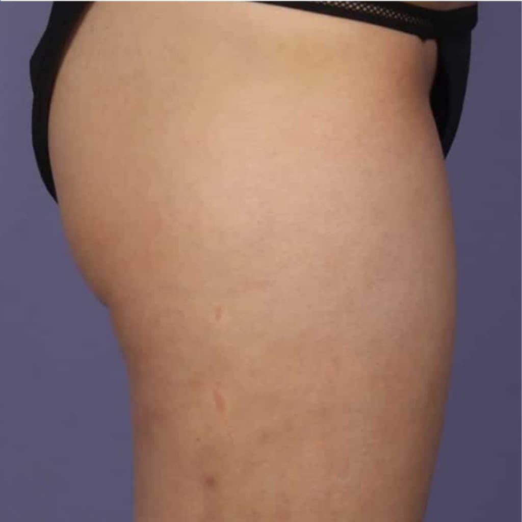 Carebudd™ Anti-Cellulite Suction Cup draft